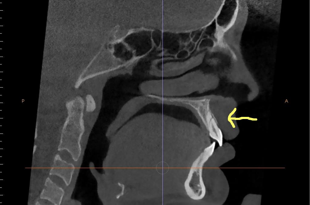 does-dental-insurance-cover-cone-beam-ct-scan-the-best-picture-of-beam